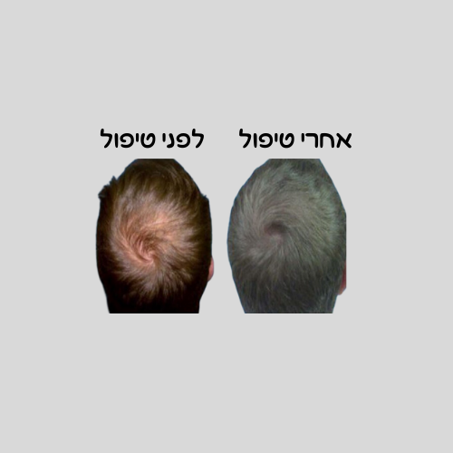 טיפול PRP לנשירת שיער